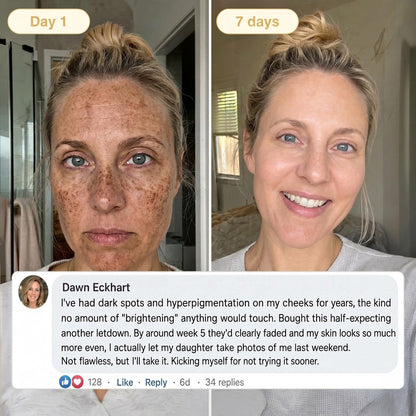 🎁 𝐇𝐢𝐬𝐤𝐢𝐧® Exclusive Offer | Only 5 Boxes Left — Get an Extra 80% OFF Today on the Turmeric × Kojic Acid Overnight Peel-Off Mask. Grab Yours Before It’s Gone! 🎁
